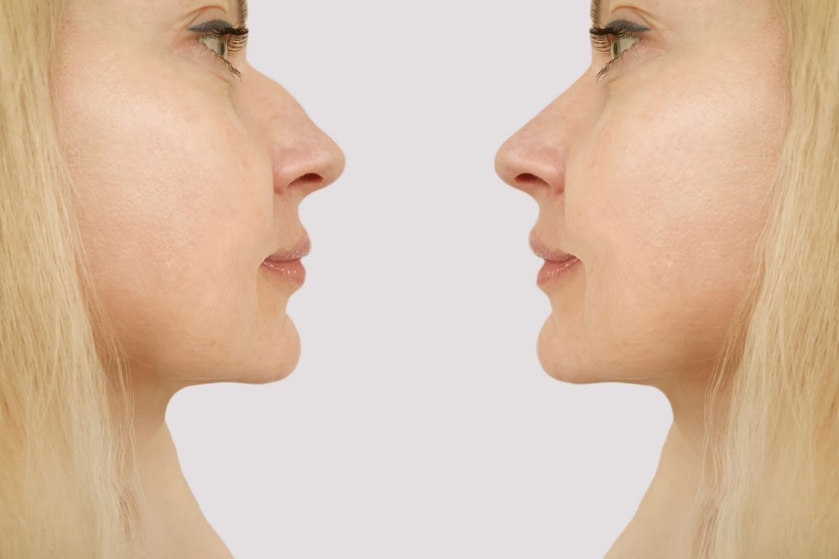 cirurgia de nariz antes e depois
